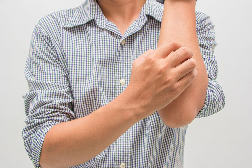 Eczema &#8211; Signs, Symptoms, and Home Remedies